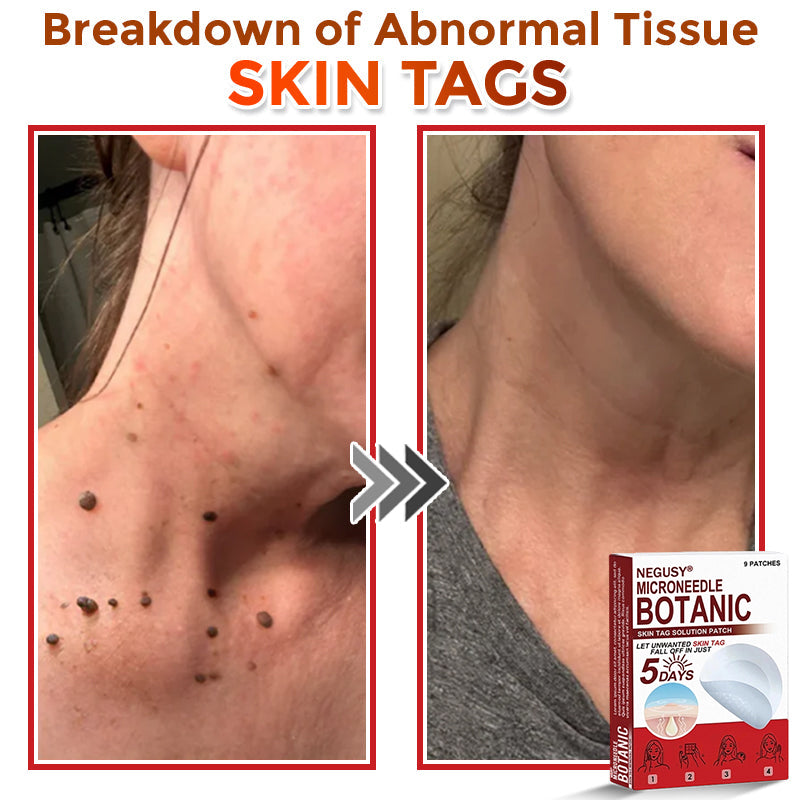 NEGUSY™ Removal Patch: Gentle Microneedle Patches for SkinTag & Mole Removal