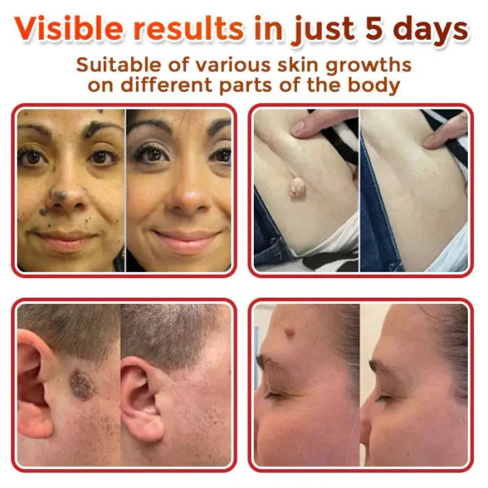 NEGUSY™ Removal Patch: Gentle Microneedle Patches for SkinTag & Mole Removal